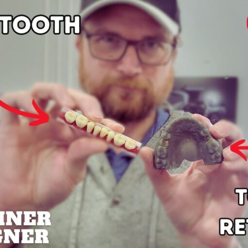 Adding a Tooth (Pontic) To a Retainer. Plus A Bonus Tip!