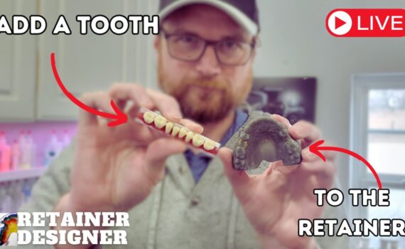 Adding a Tooth (Pontic) To a Retainer. Plus A Bonus Tip!